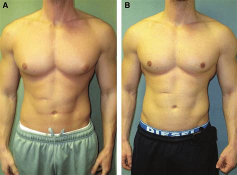 Just did my surgery, he is excellent I would totally recommend him for gynecomastia surgery. . Can you build muscle after gynecomastia surgery